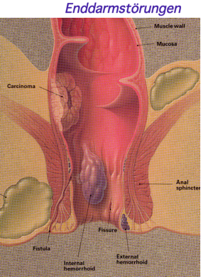 Genital Wart (Condyloma Acuminatum) in Adults: Condition ...