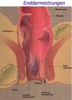 Genital Wart (Condyloma Acuminatum) in Adults: Condition ...